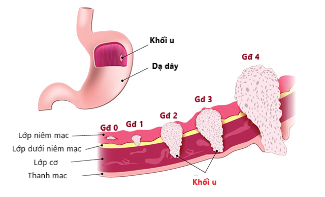 Ung thư dạ dày: Chẩn đoán và điều trị - Ảnh 1.